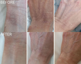 BOTANICSENS Ph.D ATO Formula Intense Defense All-In-One Lotion, 380ml, 12.85 fl. oz., Before and After Review Repairing Skin Barrier with BOTANICSENS