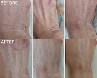 BOTANICSENS Ph.D ATO Formula Intense Defense All-In-One Lotion, 380ml, 12.85 fl. oz., Before and After Review Repairing Skin Barrier with BOTANICSENS